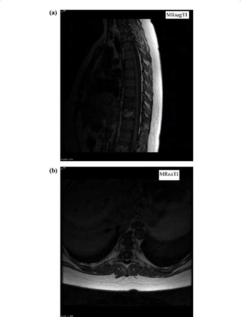 A And B Mri T1 Sagittal And Axial Images Demonstrating A Predominantly Download Scientific