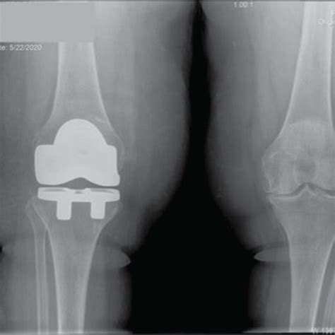 Postoperative Ap A And Lateral B X Rays Of The Right Knee For Case 1 Download Scientific