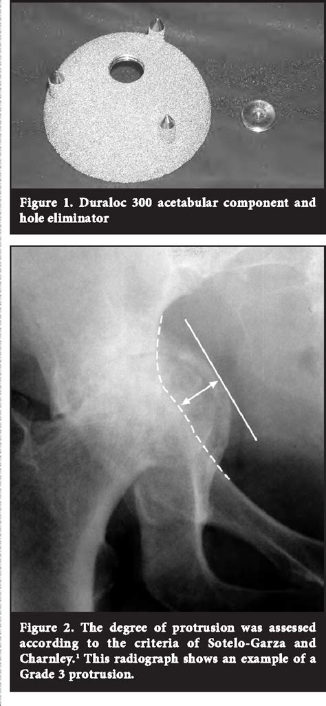 Figure From The Results Of A Cementless Acetabular Component Combined