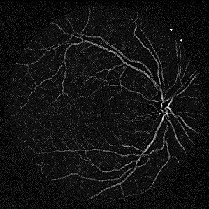 Diabetic Retinopathy Detection Using Hybrid Classifier