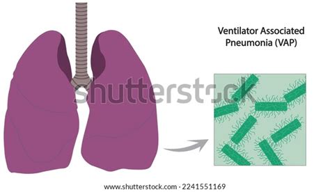 Ventilator Associated Pneumonia Vap Illustration Infection Stock Vector Royalty Free