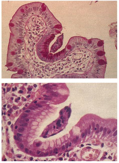 Figure Biopsy Taken From The Duodenal Bulb A Ab Pas Staining X200 Download Scientific