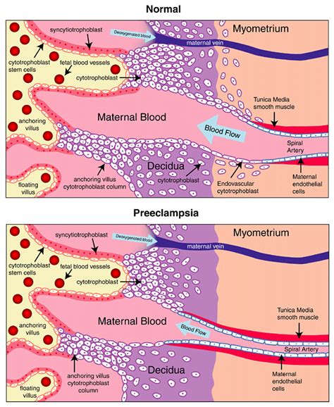 Preeclampsia Symptoms Risk Factors Prognosis Schoolworkhelper