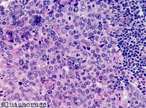 Pathology Of Medullary Carcinoma Breast Pathology Made Simple