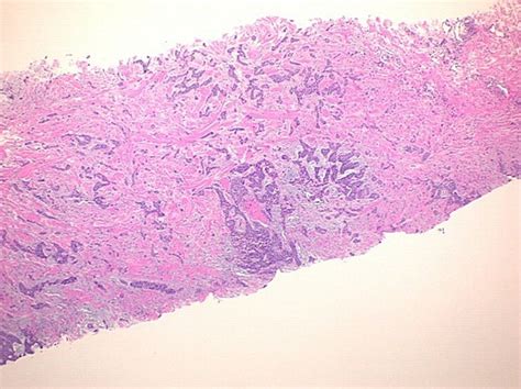 Metastatic Basal Cell Carcinoma Presenting With Unilateral Upper Extremity Edema And Lymphatic