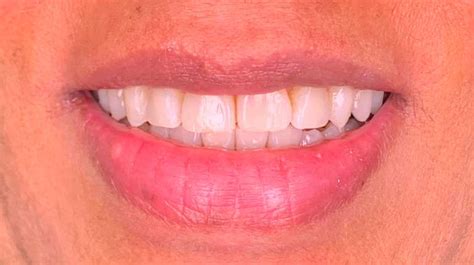 Before And After Photos Invisalign® Clear Braces Gallery Odessa Fl