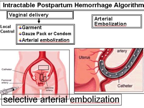 Uterine Artery Embolization For Postpartum Hemorrhage