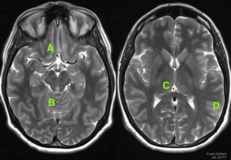 Area Postrema Mri Anatomy