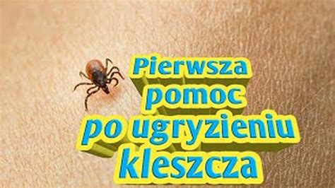 360 Pierwsza Pomoc Po Ugryzieniu Kleszcza Co My Robimy CDA