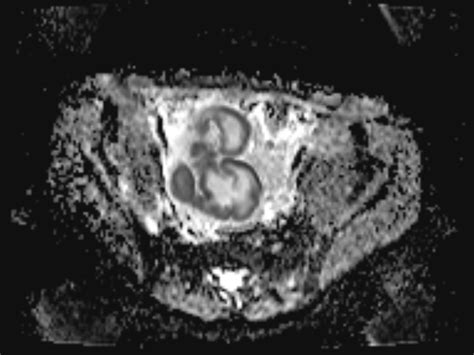 Tubo Ovarian Abscess Image