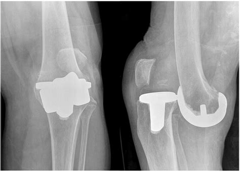 Anterior Tibiofemoral Dislocation Of Total Knee Arthroplasty