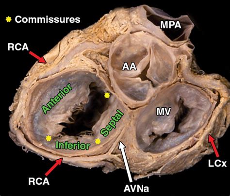 Imaging Evaluation Of Tricuspid Valve Analysis Of Morphology And