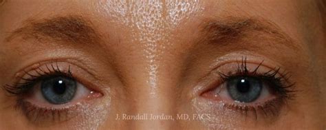 Brow Lift Case 2380 Faces PLLC In Ridgeland MS