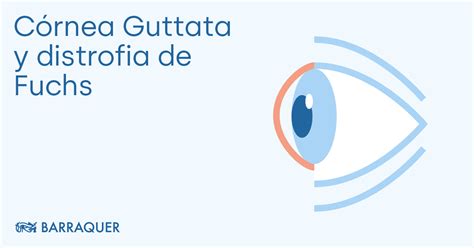 Cornea guttata and Fuchs dystrophy | Symptoms and treatment