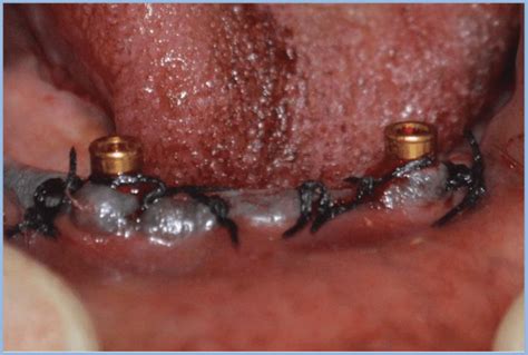 Two implants placed and locator attachments were immediately attached.... | Download Scientific ...