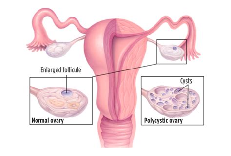 Polycystic Ovary Syndrome What Is It Part I