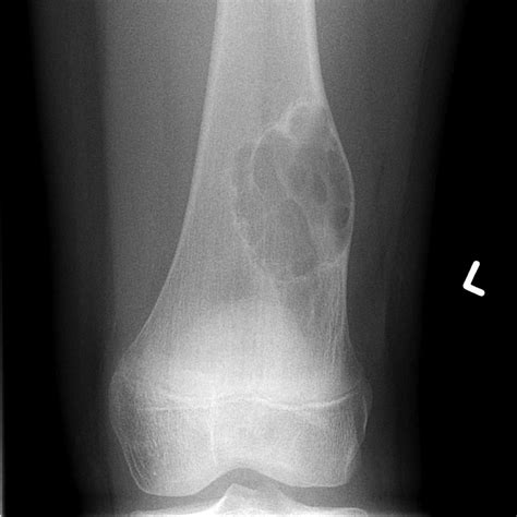 Non-ossifying fibroma: distal femur | Radiology Case | Radiopaedia.org ...