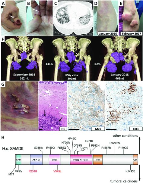 Clinical Features Of MCTD And Progression Of Soft Tissue Calcifications