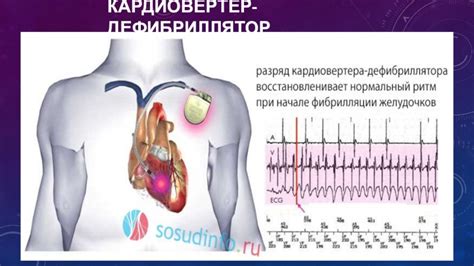 Кардиовертер (дефибриллятор): установка, рекомендации