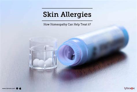 Skin Allergies - How Homeopathy Can Help Treat it? - By Dr. Ritu Singh ...