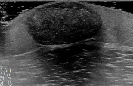 Pilomatricoma Ultrasound And MRI Radiology Case Radiopaedia Org