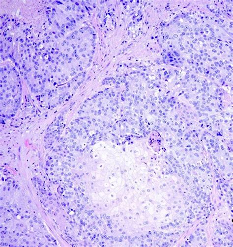 Pathology Outlines Adenosquamous Carcinoma