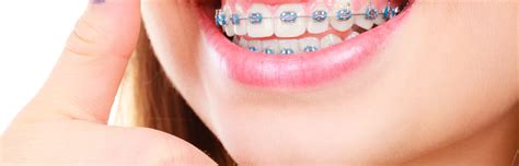 Is Blue a Good Color for Braces? - The Braces Guide