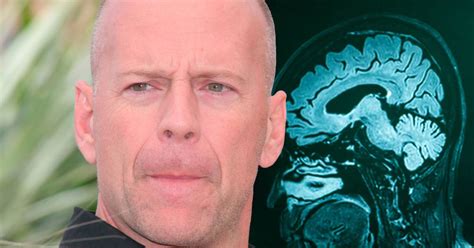 Bruce Willis es diagnosticado con demencia frontotemporal Qué es y