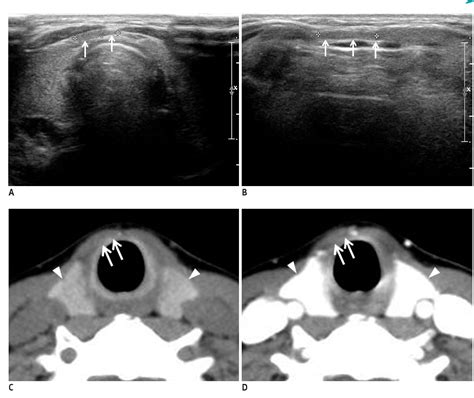 Figure 1 From Comparison Between Ultrasonography And Computed Tomography For Detecting The