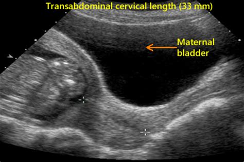 Cervix - OB Images - OB Images