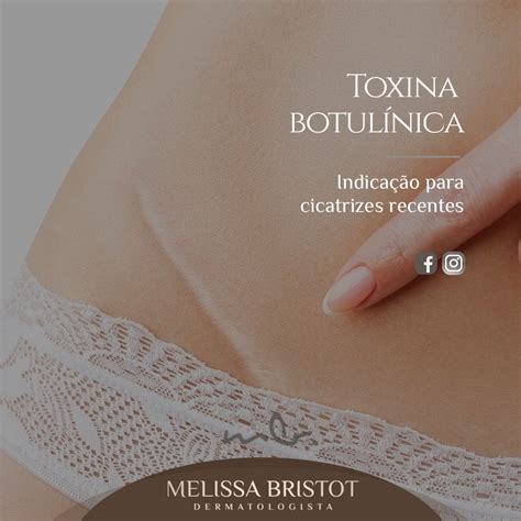 Dra Melissa Bristot Dermatologista Indicação de Toxina Botulínica