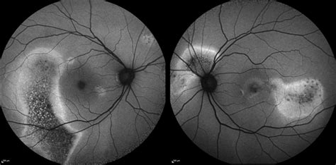 Central Serous Chorioretinopathy Retina Image Bank