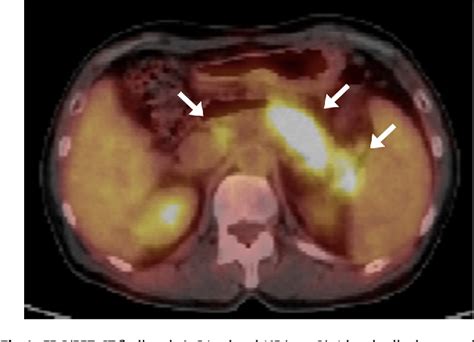 The Utility Of Fdg Pet Ct And Other Imaging Techniques In The