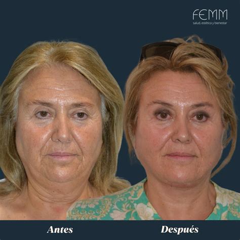 Lifting Cervicofacial Caso Cirug A Est Tica Madrid Cl Nica Femm