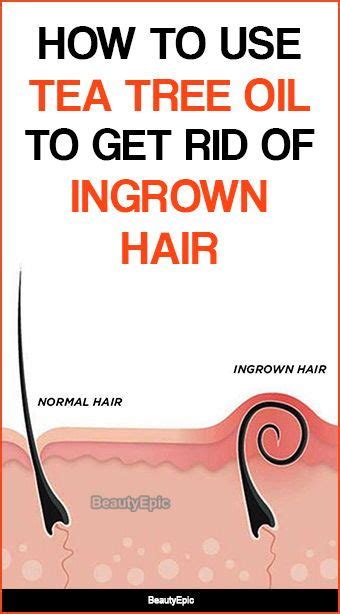 How Effective Is Using Tea Tree Oil For Ingrown Hair Artofit