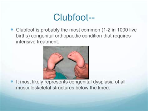 Clubfoot Ppt