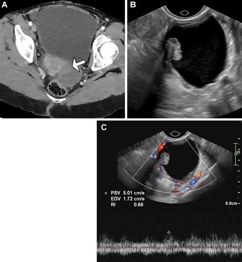 Benign Appearing Incidental Adnexal Cysts At Us Ct And Mri Putting The Acr O Rads And Sru