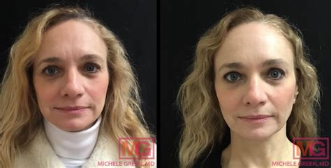 Juvederm Cheek Fillers Juvederm Voluma For Cheeks Dr Michele Green M D