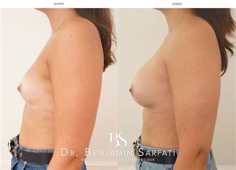 Augmentation Mammaire Paris Proc Dure Mia Dr B Sarfati