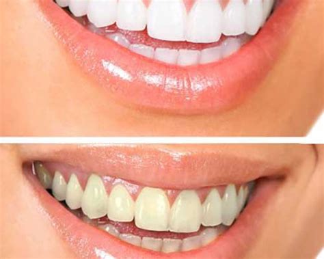 TEETH WHITENING