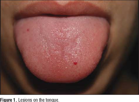 Hereditary Hemorrhagic Telangiectasia Tongue