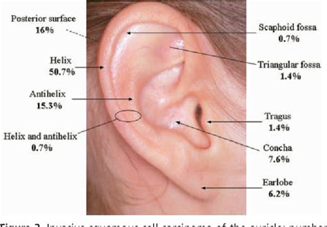 Squamous Cell Carcinoma Of The Auricle And Mohs Micrographic Surgery