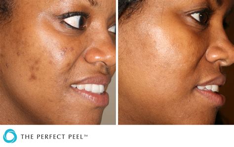 Chemical Peels Perfect Peel Renew Medical Aesthetics Cheshire