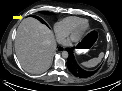 Pneumoperitoneum Surgical Clinics