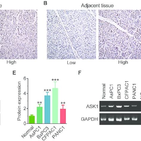 ASK1 Is Overexpressed In Pancreatic Cancer A B Representative Images