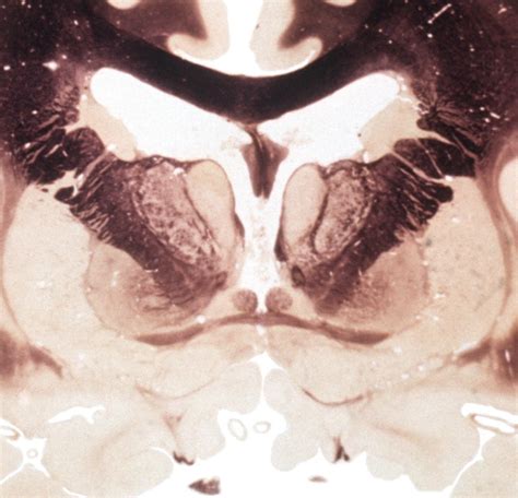 CORONAL THALAMUS ANTERIOR ANTERIOR COMMISSURE Diagram Quizlet