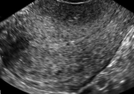 Adenomyosis Of The Uterus Ultrasound Findings | Hot Sex Picture