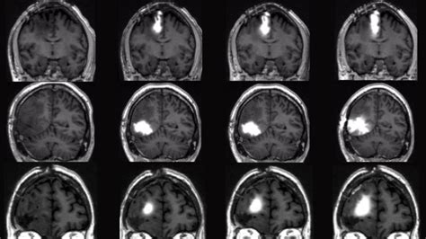 Implanted Pump Safely Delivered Chemo Straight To The Brain In Patients