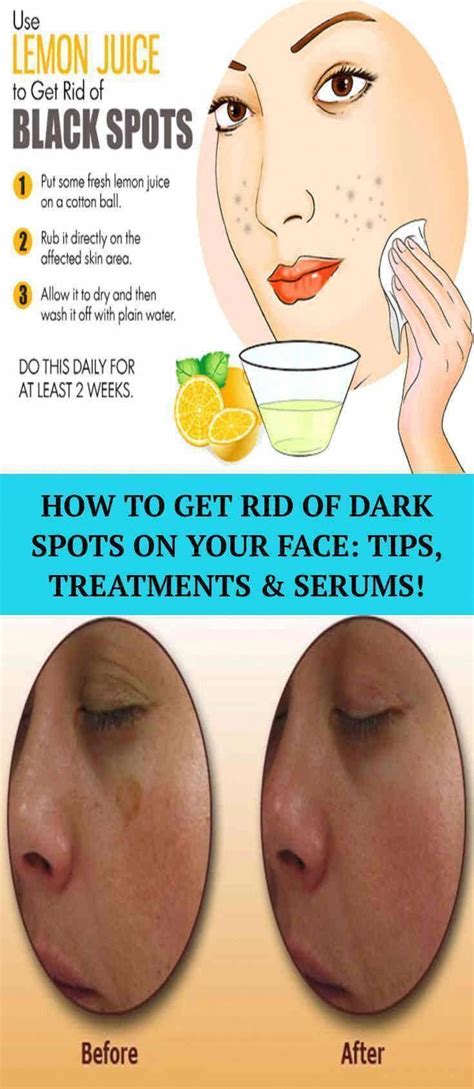 How To Get Rid Of Brown Spots On Face BrownSpotsOnHands