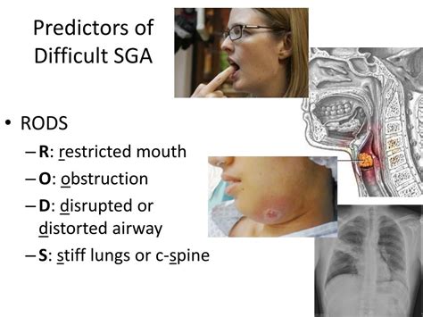 PPT 3 Intro To EM Airway Management Assessment And SupraGlottic